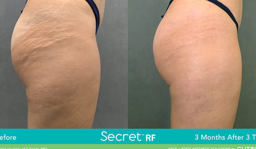 laser stretch mark removal results mississauga oakville